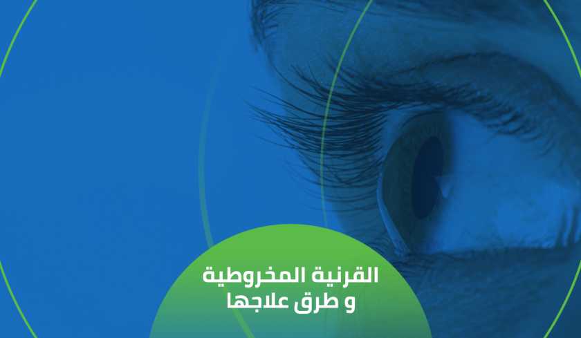 علاج مرض القرنية المخروطية