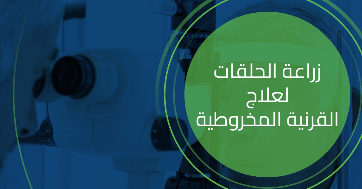 زراعة الحلقات لعلاج القرنية المخروطية