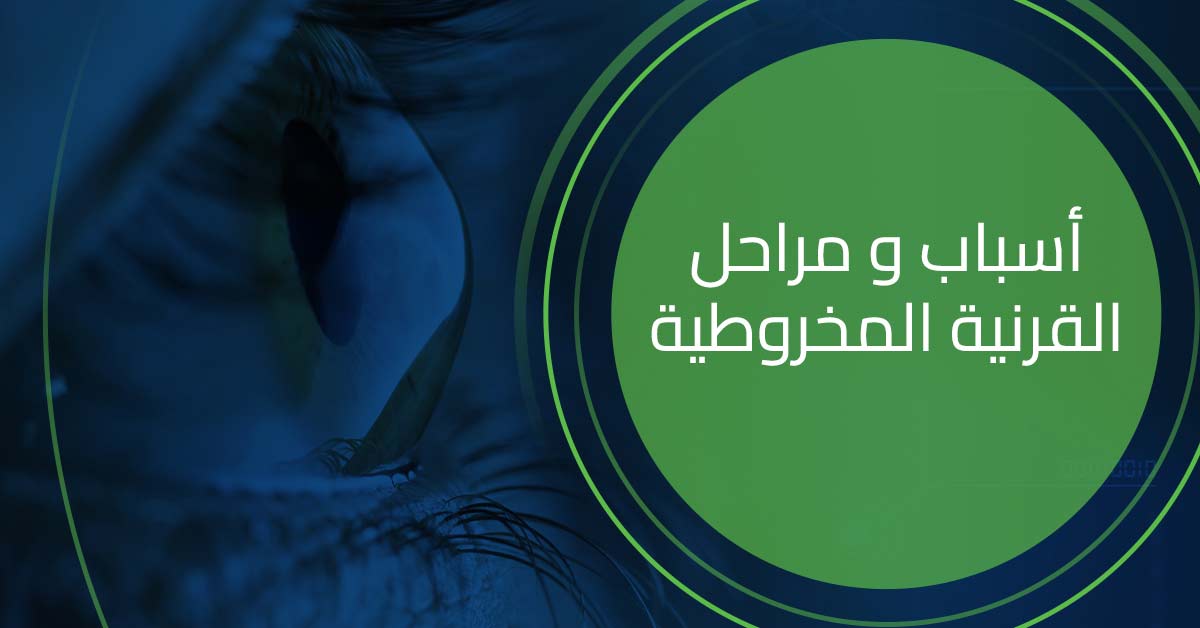 تعرف على أسباب ومراحل القرنية المخروطية