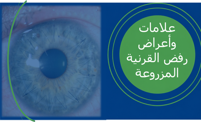 علامات وأعراض رفض القرنية المزروعة