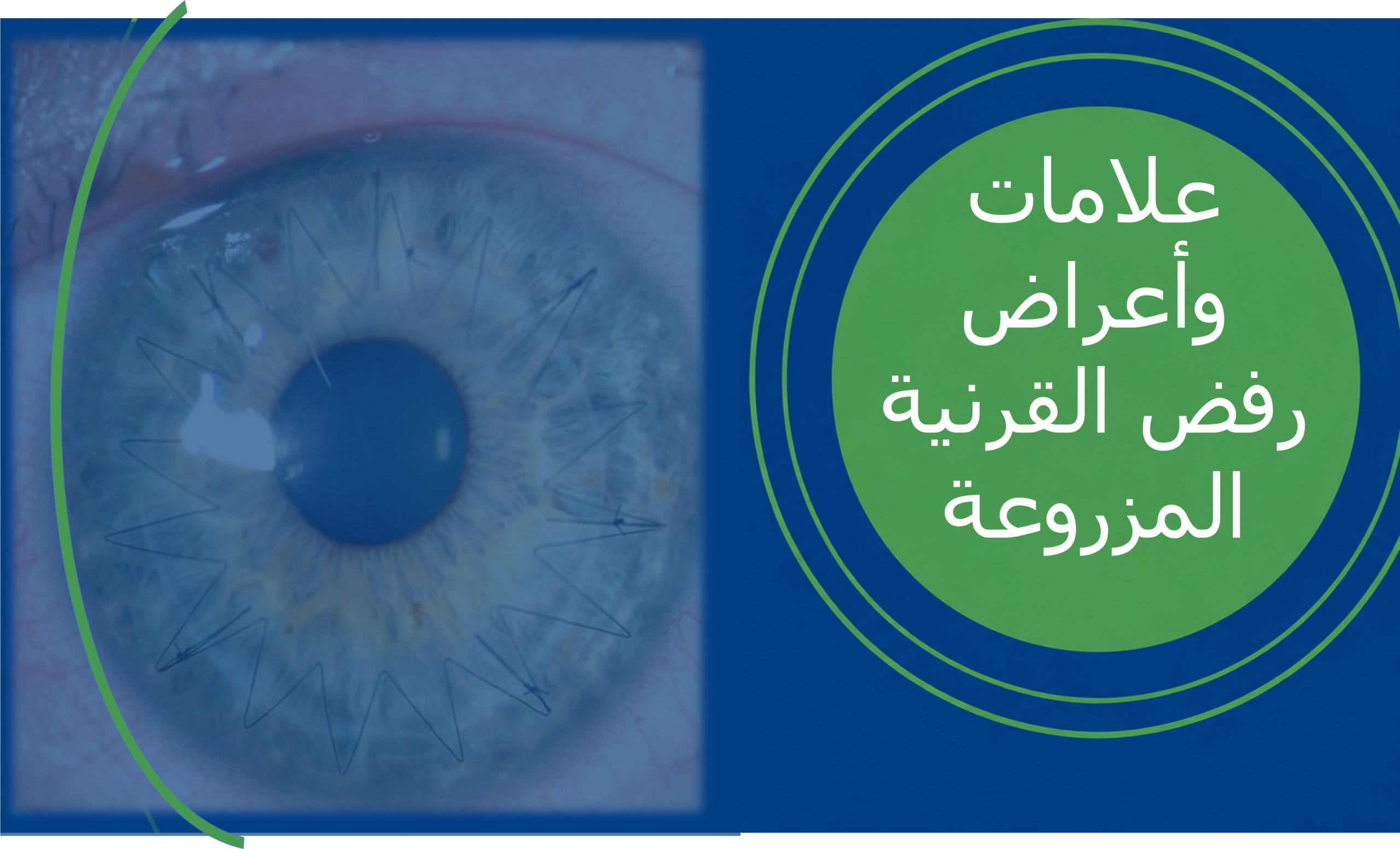 علامات وأعراض رفض القرنية المزروعة